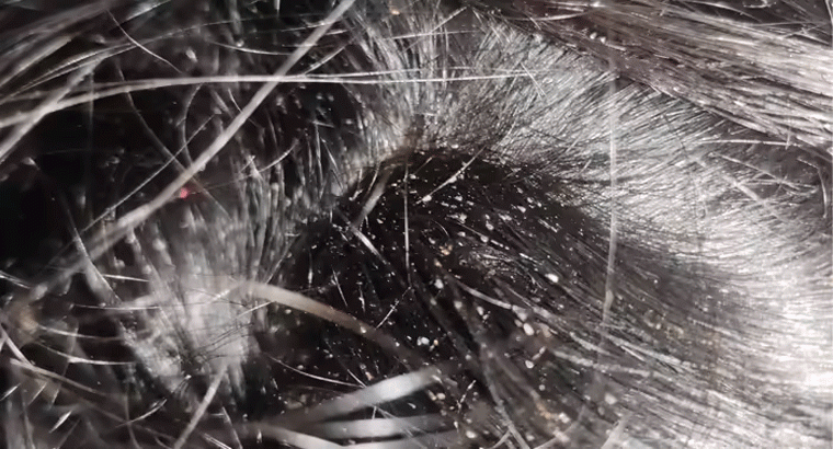 తలలో పేలు పోగొట్టేందుకు ఎక్స్ పర్ట్ చెప్పిన చిట్కాలు, పాటిస్తే అంతా క్లియర్