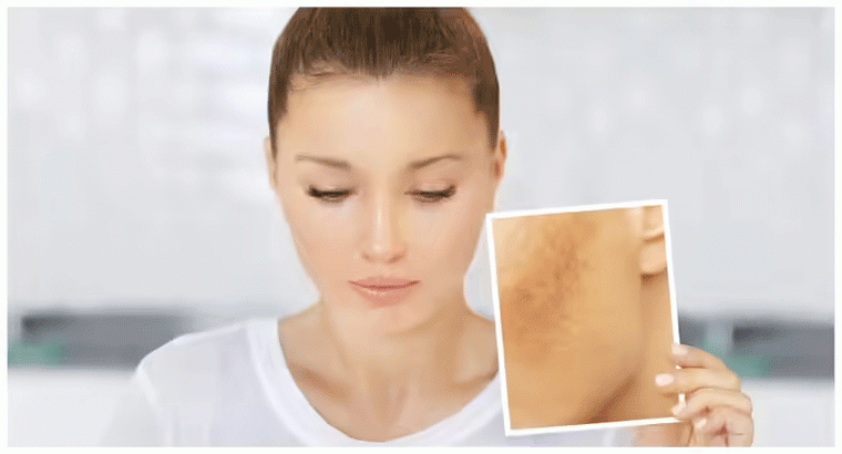 యాక్నే, ముఖంపై మచ్చలు తగ్గేందుకు ఒక్క ఆయిల్ చాలు