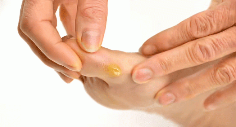 ఆనెలను పోగొట్టేందుకు ఎక్స్ పర్ట్ చెప్పిన సింపుల్ చిట్కా