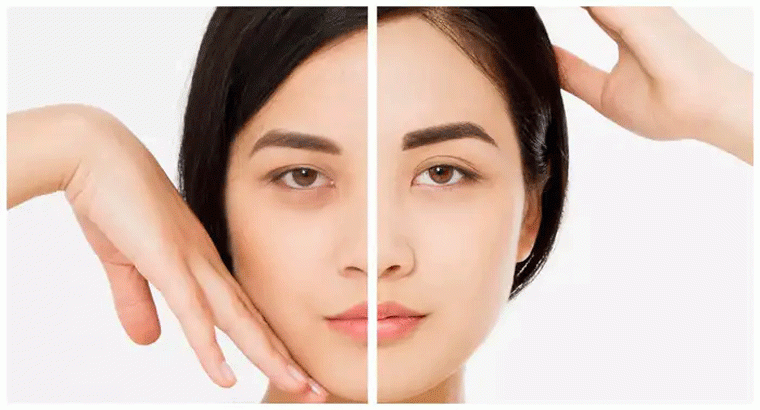 కళ్ల చుట్టూ డార్క్ సర్కిల్స్,,,కొన్ని రోజుల్లోనే నల్లని వలయాలు దూరం