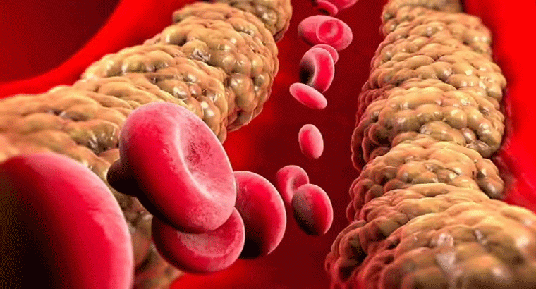 ఎలాంటి లక్షణాలు లేకుండానే శరీరంలో కొలెస్ట్రాల్ స్థాయిలు పెరుగుతాయా