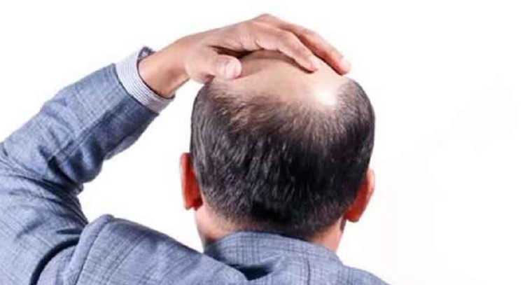 శీత‌ల‌పానియాలు అధికంగా తాగితే జుట్టు రాలుతుందా?

