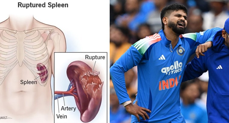 టీమిండియాకు షాక్.. శ్రేయస్ అయ్యర్‌కు అంతర్గత గాయం.. ఐసీయూలో ప్రత్యేక చికిత్స!

