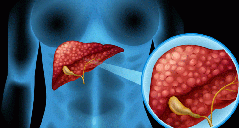 ఫ్యాటీ లివర్ సమస్యతో బాధపడుతున్నారా? డాక్టర్ సూచించిన సింపుల్ హోమ్ టిప్స్ ఇవే