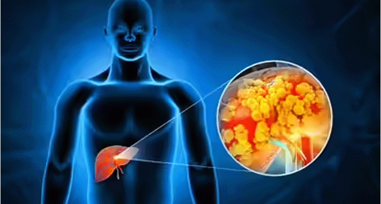 లివర్ సమస్య ముందే హెచ్చరిస్తుంది – ఈ లక్షణాలు గుర్తించారా?