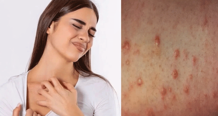 Health Alert: ఈ చర్మ సమస్యలు మధుమేహం సంకేతం కావచ్చు!
