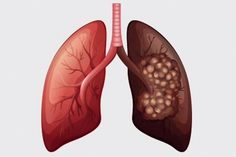Lung Infection Alert: ఊపిరితిత్తుల ఇన్ఫెక్షన్‌ను ఇలా గుర్తించాలి