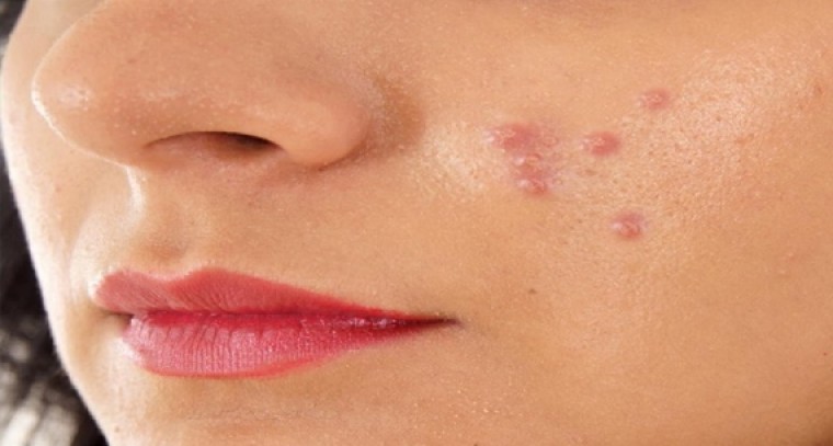 యాక్నే లేని ముఖారవిందం కోసం... 

