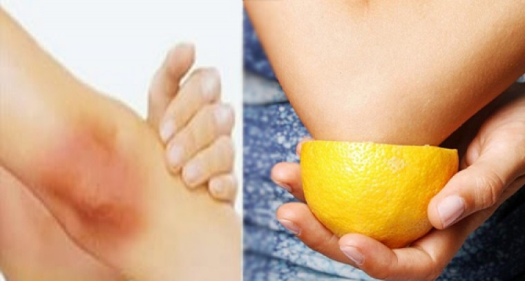 మోచేతి నలుపుకు ఇలా చెక్ పెట్టండి.... 

