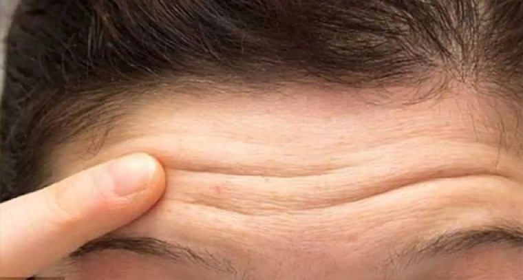 ముఖం పై ముడతలు పోవాలంటే... 

