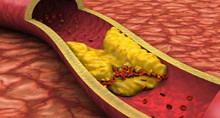 గుండె ధమనుల్లో కాల్షియం పేరుకుపోతే.. పరిణామాలు, పరిష్కారాలు..!

