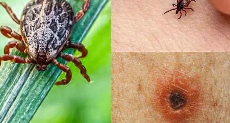 చిగ్గర్ పురుగు కాటు.. స్క్రబ్ టైఫస్ వ్యాధి గురించి తెలుసుకోవాల్సిన ముఖ్య విషయాలు

