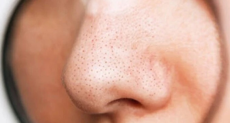 ముక్కుపై నల్లటి మచ్చలా? ఇంట్లోనే ఈ చిట్కాలతో బ్లాక్ హెడ్స్‌కు చెక్ పెట్టండి!

