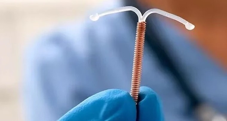 కాపర్ టీ...సురక్షిత గర్భనిరోధకం, సరైన జాగ్రత్తలతో!

