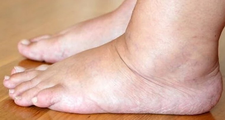 డెలివరీ తర్వాత కాళ్ల వాపులా? నిర్లక్ష్యం చేయకుండా ఈ జాగ్రత్తలు పాటించండి!

