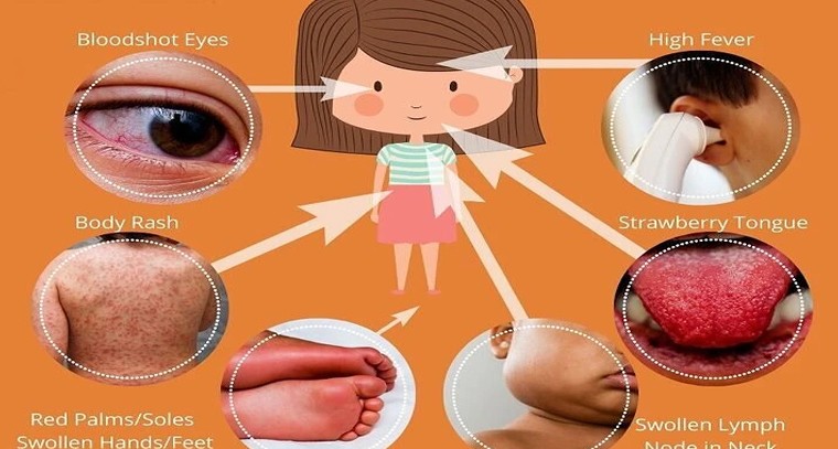 చిన్నారుల గుండెపై 'కవాసకి' పంజా: తల్లిదండ్రులు అప్రమత్తంగా ఉండాల్సిందే!

