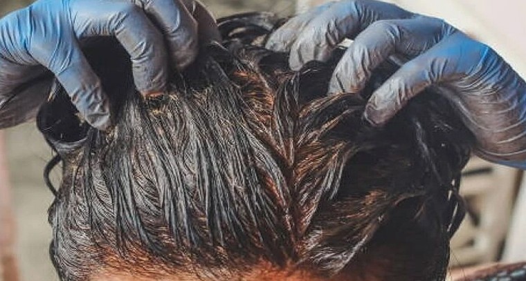 చుండ్రుకు చెక్.. హెన్నా, ఆవనూనెలతో ఇంట్లోనే శక్తివంతమైన చిట్కాలు

