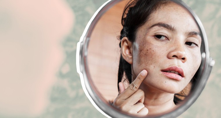 మొకంపై మొటిమలు, నల్లటి మచ్చల సమస్యలకు ఈ చిట్కా అద్భుతంగా పని చేస్తుంది..!

