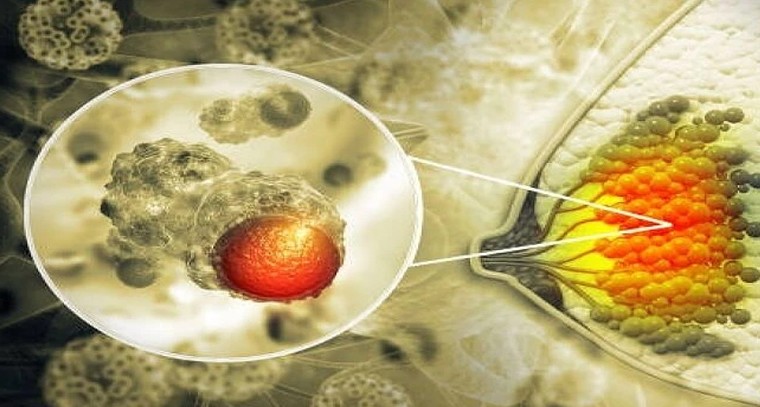 రొమ్ము క్యాన్సర్.. చికిత్స తర్వాత కూడా అప్రమత్తత ఎందుకు అవసరం? తిరిగి వచ్చే ప్రమాదాన్ని ఎలా గుర్తించాలి?

