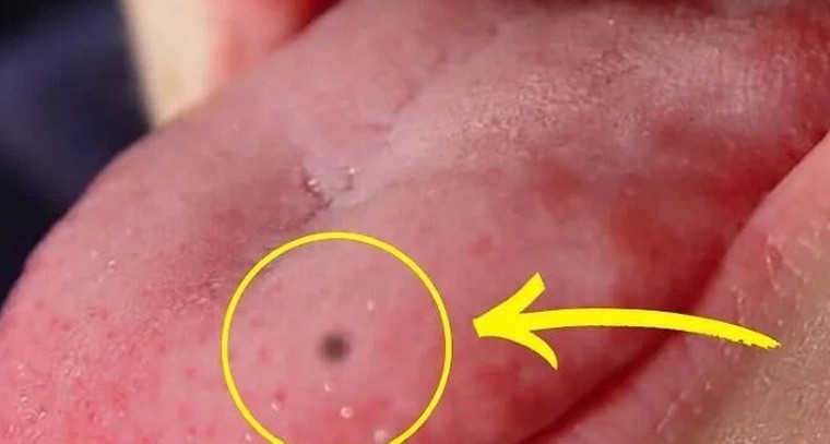 నాలుకపై పుట్టుమచ్చ ఉంటే 'వాక్కు' నిజమవుతుందా?.. దీని వెనుక ఉన్న అసలు రహస్యాలివే

