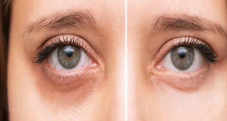 కళ్ల కింద నల్లటి వలయాలు ఇబ్బంది పెడుతున్నాయా?