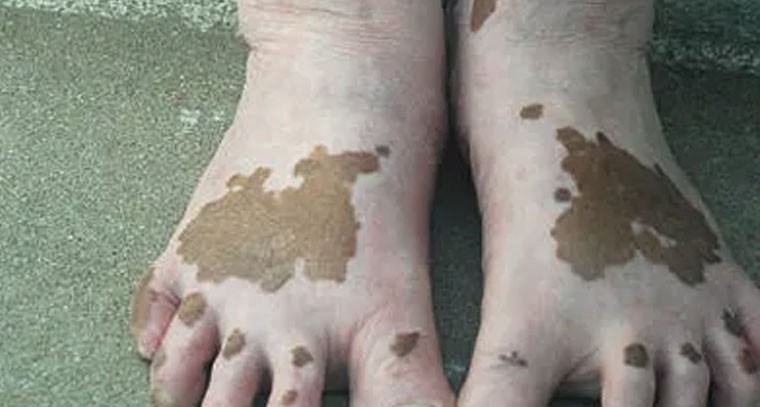 బొల్లి ఎలా వస్తుందంటే..