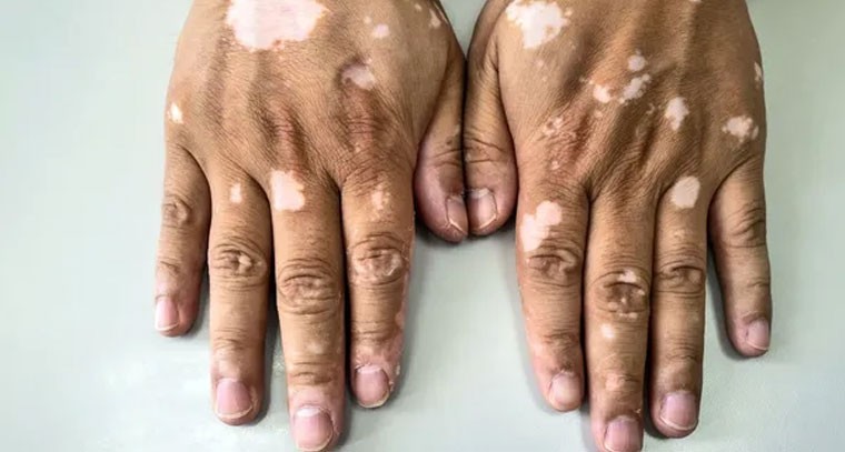 బొల్లి మచ్చలను సహజంగా తగ్గించుకునే మార్గం ఇదే!