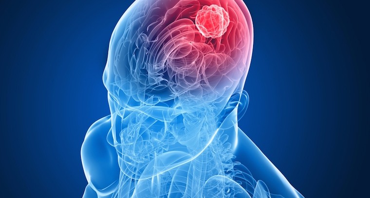 బ్రెయిన్ ట్యూమర్‌లో తలనొప్పి లక్షణాలు