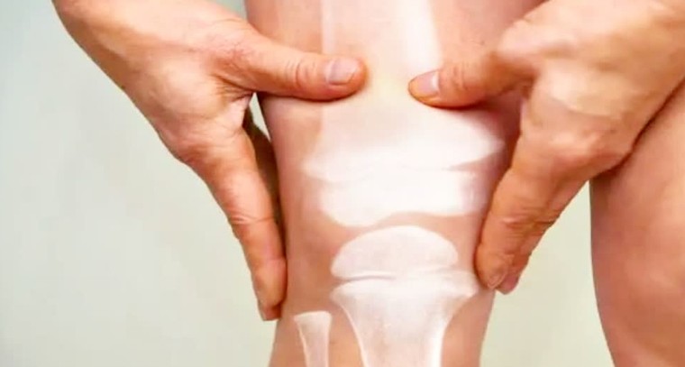 క్యాల్షియం లోపం వల్ల కలిగే అనారోగ్య సమస్యలు