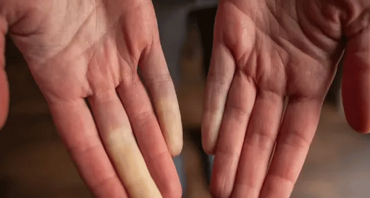 చలికాలంలో చేతులు, కాళ్లు మొద్దుబారడం.. నరాల బలహీనతకు సంకేతమా?