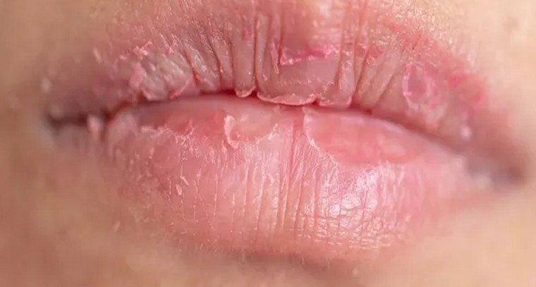 చలికాలంలో పెదవులు పగిలితే ఈ చిట్కాలు పాటించండి