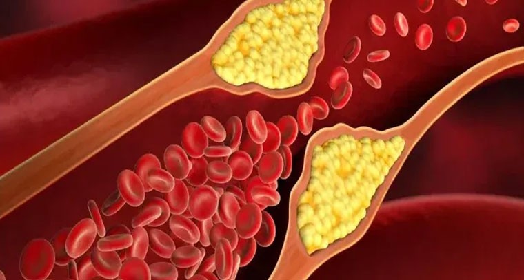 చెడు కొలెస్ట్రాల్‌ను సూచించే లక్షణాలు ఇవే!