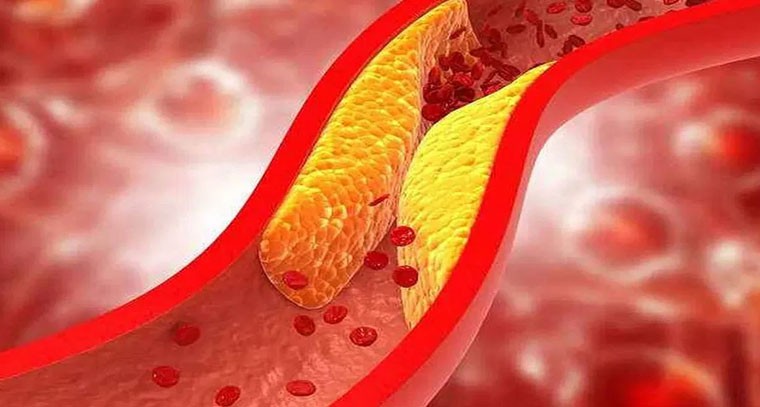 మహిళల్లో అధికంగా పెరుగుతున్న కొలెస్ట్రాల్