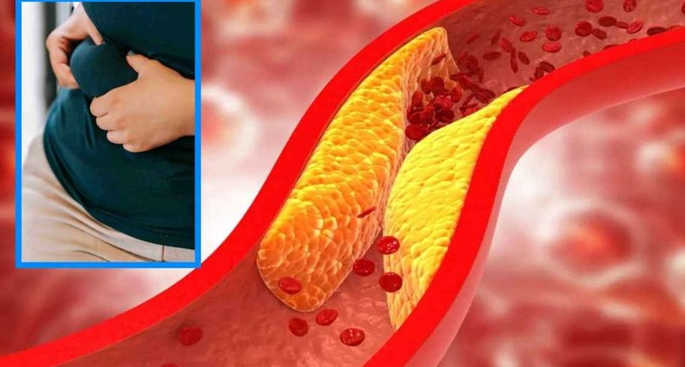 అధిక కొలెస్ట్రాల్‌కి ఎలా చెక్ పెట్టాలి..