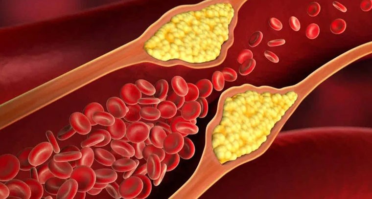 అధిక కొలెస్ట్రాల్.. లక్షణాలు లేని సైలెంట్ కిల్లర్
