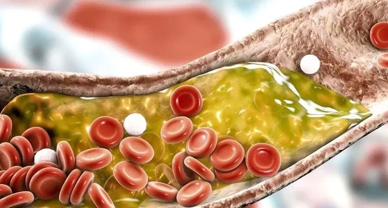 చెడు కొలెస్ట్రాల్ పెరగడానికి కారణం ఏంటి