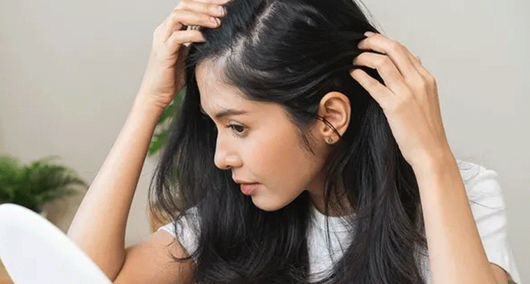 చుండ్రు తగ్గించే సహజసిద్ధమైన చిట్కాలు ఇవే!