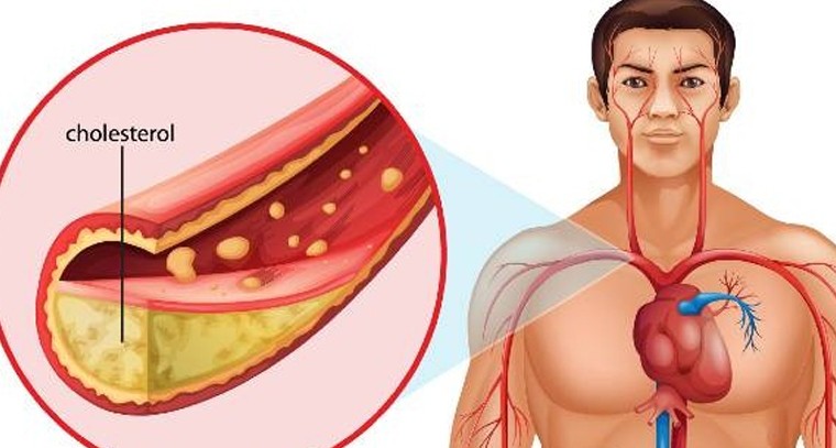  కొలెస్ట్రాల్ను ఎలా తగ్గించాలి?