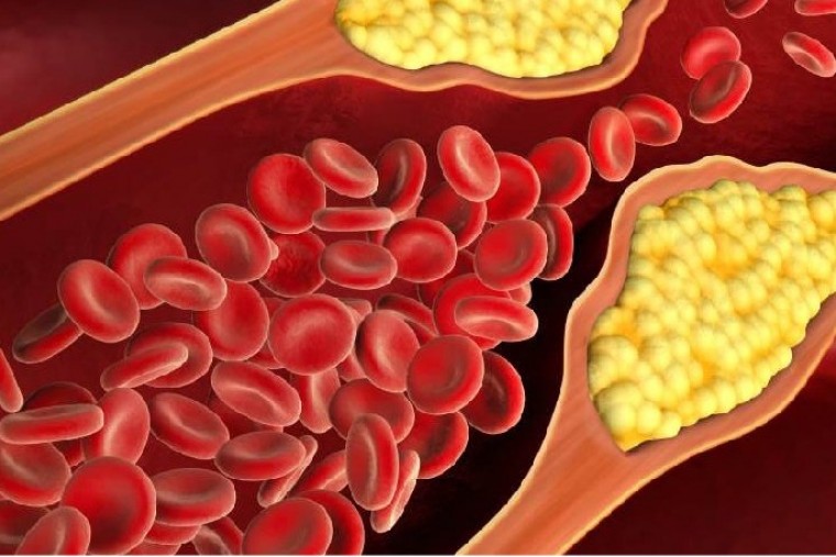 ఎంత ఎక్కువ కొలెస్ట్రాల్, మైక్రోప్లాస్టిక్స్ గుండె జబ్బులు పెరగడానికి దోహదం చేస్తున్నాయి