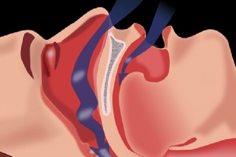 ఆస్ట్రేలియన్ పరిశోధన గురక, పెరిగిన రక్తపోటు మధ్య సంబంధాన్ని కనుగొంది