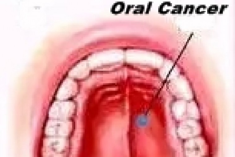 ధూమపానం లేని పొగాకు, తమలపాకులు భారతదేశంలో నోటి క్యాన్సర్ కేసులు, దక్షిణాసియాలో అత్యధికం: లాన్సెట్