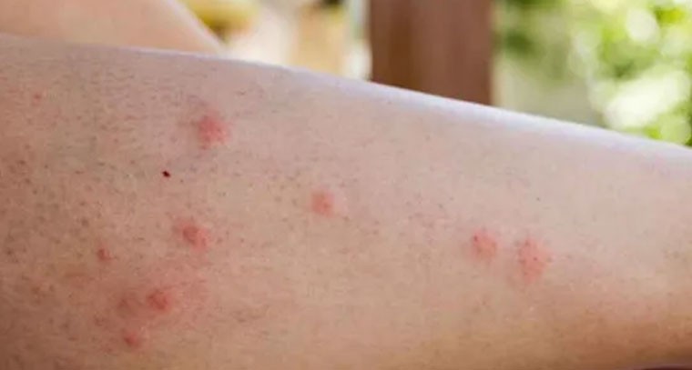 దోమలను ఆకర్షించేది మీ ఆహారమేనా? వైద్యుల సూచనలు ఇవే!