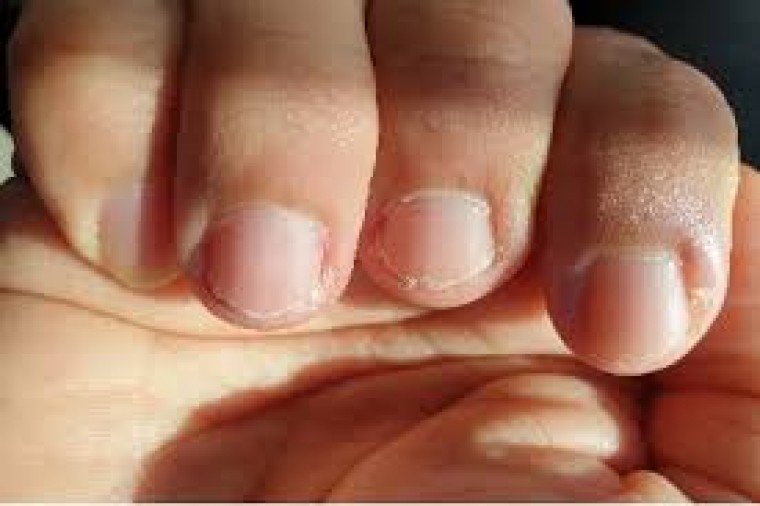 గోళ్ల రూపురేఖల్లో వచ్చే మార్పులు వివిధ వ్యాధులకు సంకేతం