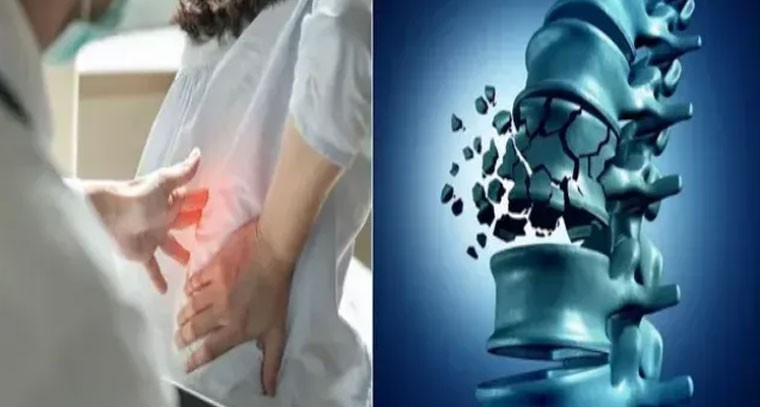 ఎముకల బలహీనత: ఆస్టియోపొరోసిస్ లక్షణాలు కావచ్చు!