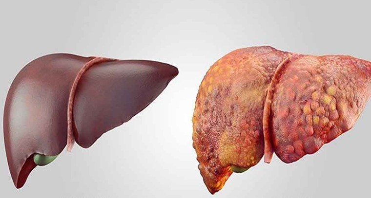ఫ్యాటీ లివర్ లక్షణాలను గుర్తించండి