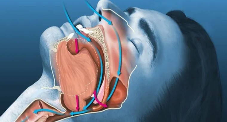 తీవ్ర గురకతో క్యాన్సర్‌ ముప్పు