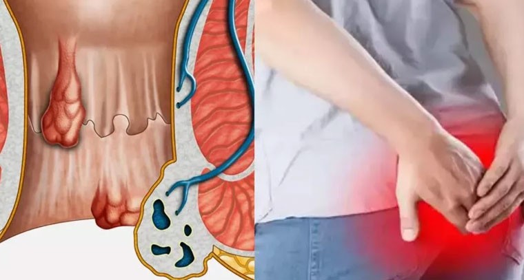 పైల్స్ నివారించడం ఎలాగో తెలుసుకోండి