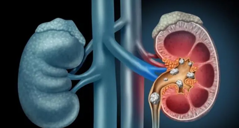 కీడ్నీ వ్యాధి లక్షణాలు