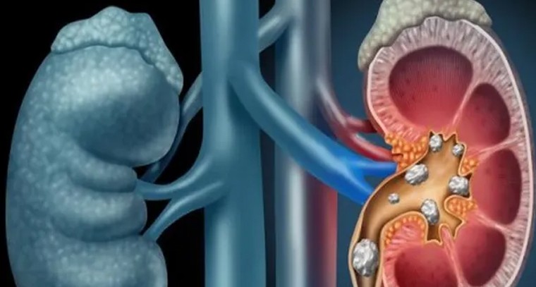 ప్రతి 10మందిలో ఒకరికి కిడ్నీలో రాళ్లు: ఎయిమ్స్ రీసెర్చ్