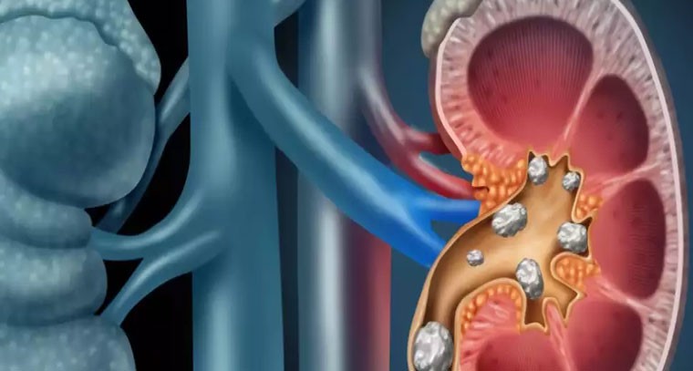 కిడ్నీలో రాళ్లను సహజంగా కరిగించే టాప్ 6 ఆయుర్వేద ఆకులు